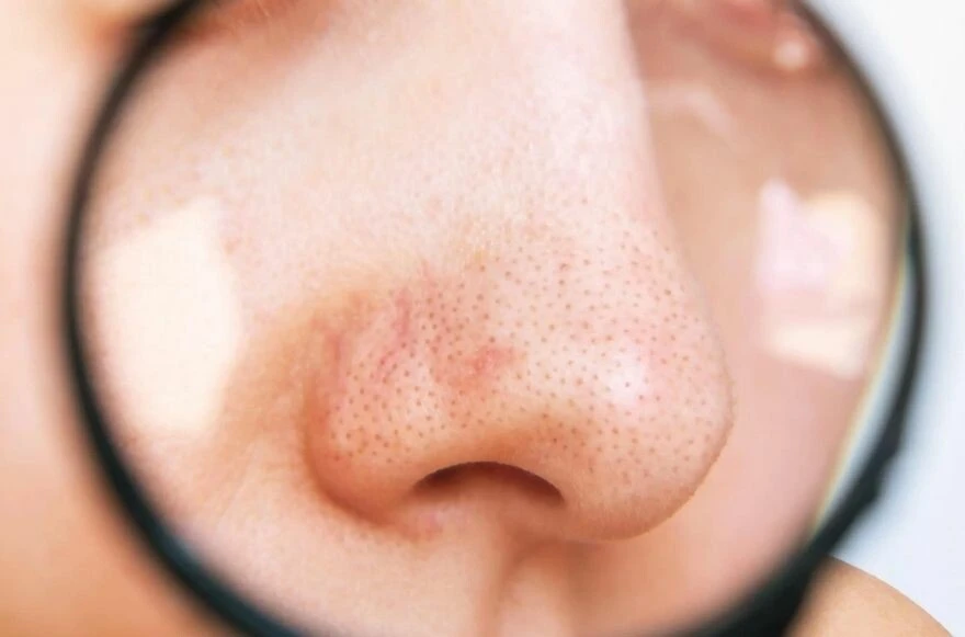 Siyah noktalar ile vedalaşın! Bu maske tarifi siyah noktalara savaş açtı!