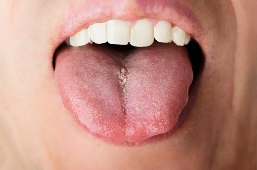 Dilinizin değişimini gözlemleyin! Dil üzerindeki lekeler hastalığın habercisi!