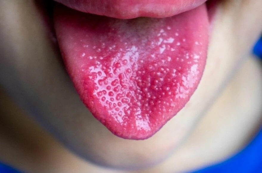 Dilinizin değişimini gözlemleyin! Dil üzerindeki lekeler hastalığın habercisi!