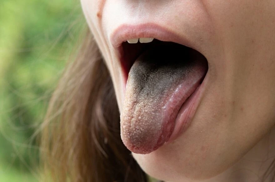 Dilinizin değişimini gözlemleyin! Dil üzerindeki lekeler hastalığın habercisi!