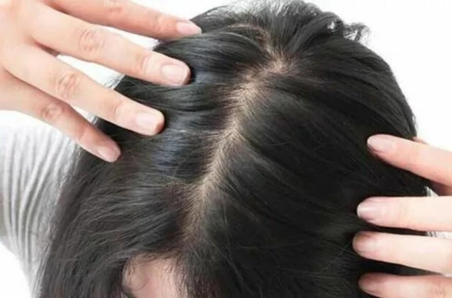 Saçları bakımsız gösteren kepeklerden kurtulmak sanıldığı kadar zor değil! Bir de bu yöntemleri deneyin! İşte kepeği geçiren yöntemler