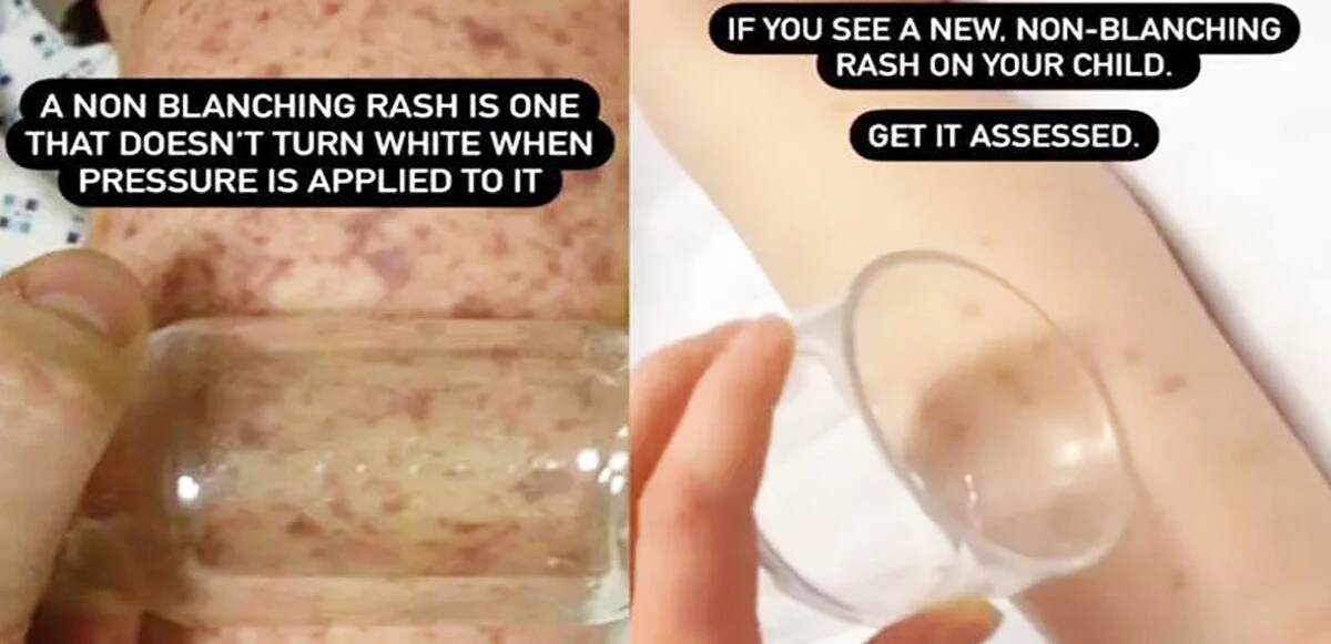 Basınç uyguladığınızda beyaza dönmüyorsa dikkat! Ebeveynlere hayati uyarı