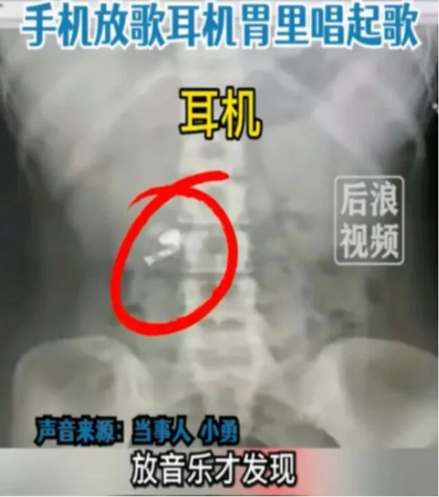 Uyurken kaybettiği kulaklığı karnından çıktı! Gelen müzik sesiyle fark etti