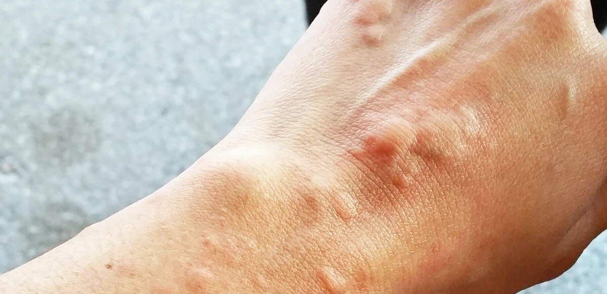 İlginç olay! Koşmaya alerjisi olan kadın uçağa yetişmeye çalışırken neredeyse ölüyordu