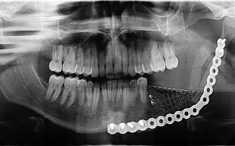 Tümöre kafa tutan kadın! 19 yıl önce kurtuldum derken bu kez elmacık kemiğinde ortaya çıktı!