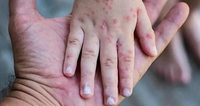 Maymun çiçeği virüsü Covid-19'un çıkış noktasında yeniden patlak verdi: 2 kişi karantinada