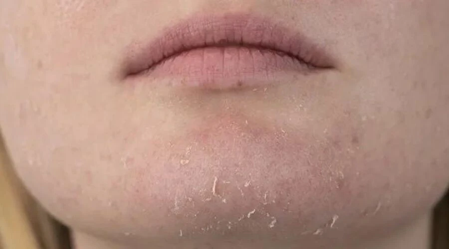 Bu yöntemle pul pul dökülen cilt sorunu çözülüyor! Kuruluktan eser kalmıyor