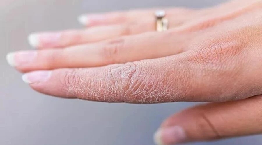 Bu yöntemle pul pul dökülen cilt sorunu çözülüyor! Kuruluktan eser kalmıyor