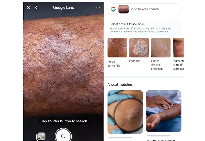 Google’dan bomba yenilik… Cildinizin fotoğrafını çekerek hastalığınızı öğrenebileceksiniz