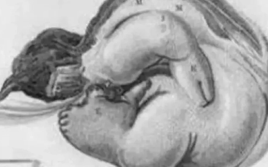 Görenler şoke oluyor! Tam 36 yıl boyunca ikizi içinde yaşadı…