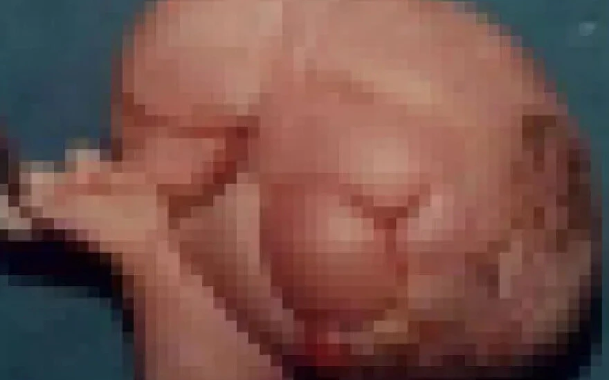 Görenler şoke oluyor! Tam 36 yıl boyunca ikizi içinde yaşadı…