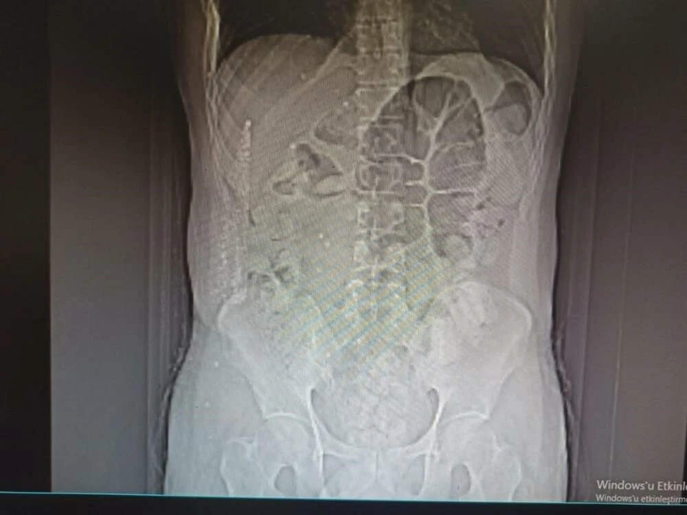 Uyuşturucu kuryesinin midesinden Afyon sakızı ortaya çıktı! 1 kişi tutuklandı
