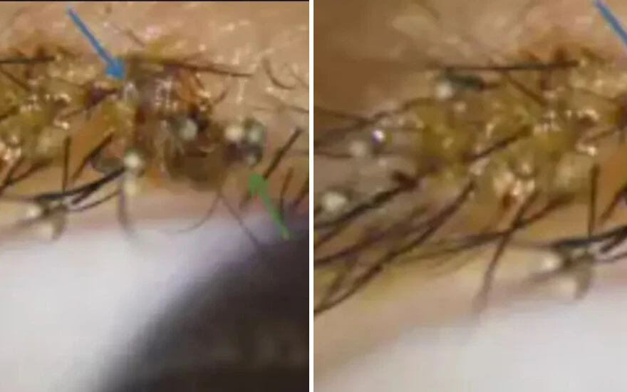 Görenler gözlerine inanamadı! 3 yaşındaki çocuğun kirpiklerine bit yuva yaptı…