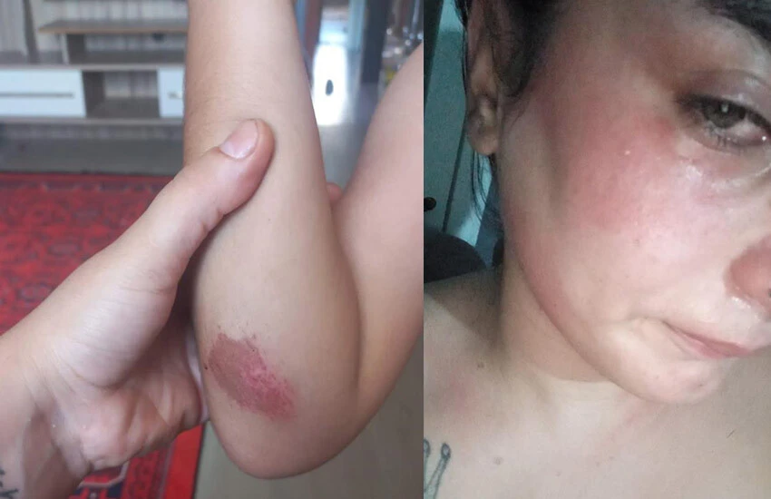 Saldırı sonrası düşük yapan hamile kadın birçok yerinde yara ve morarma izi olduğunu paylaştı.