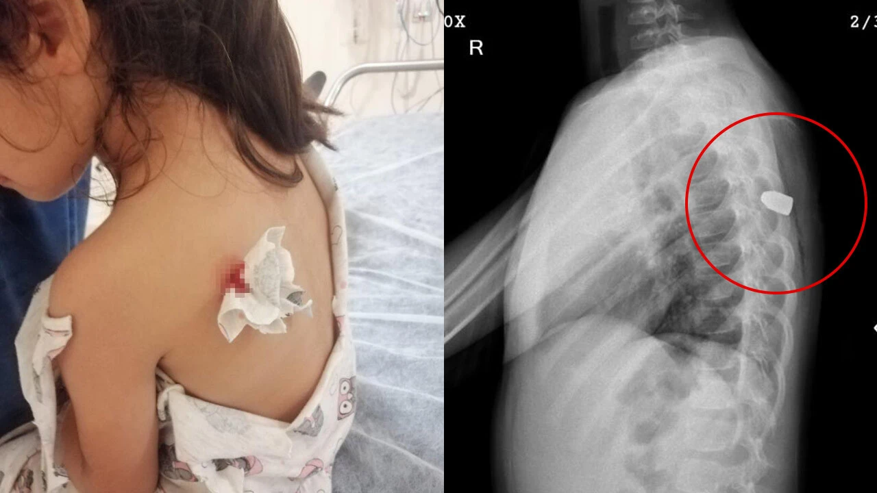 Böcek ısırığı sandı hayatının şokunu yaşadı! Gerçek hastanede ortaya çıktı