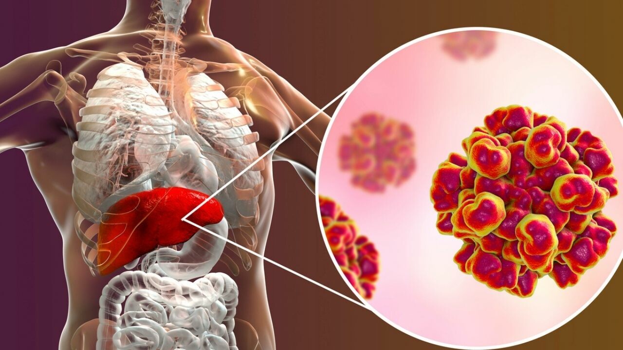 Dünyada 354 milyondan fazla kişi bu virüsle yaşıyor! Karaciğere zarar veriyor, kansere neden olabiliyor…