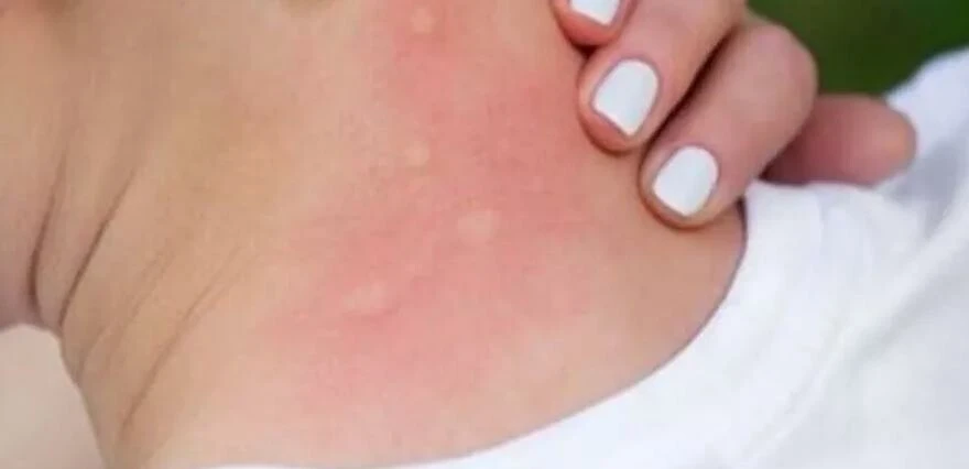 Yazlıkçılar dikkat! Tatiliniz kabus olmasın, tek bir ısırığı bile öldürebilir