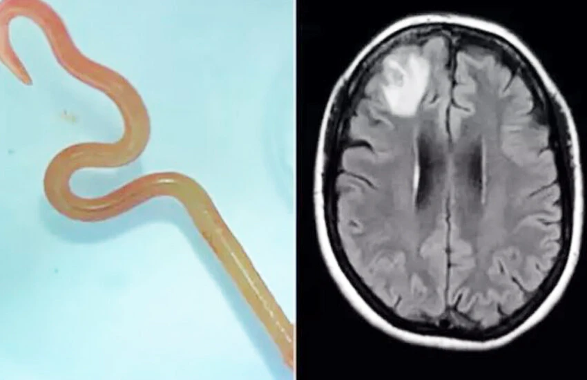 Unutkanlık ve depresyon sandı, beyninden solucan çıktı!