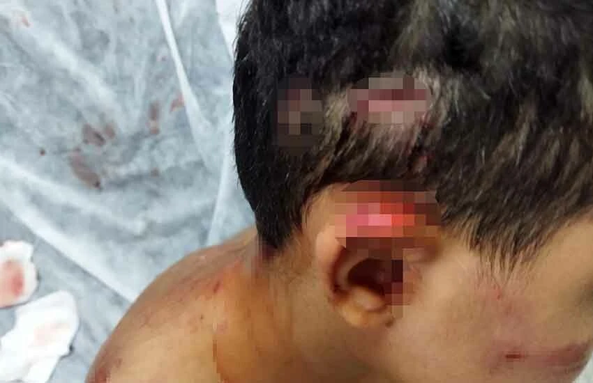 Sokak köpeği dehşet saçtı! Ölümde dönen çocuğun kafasına 25 dikiş atıldı