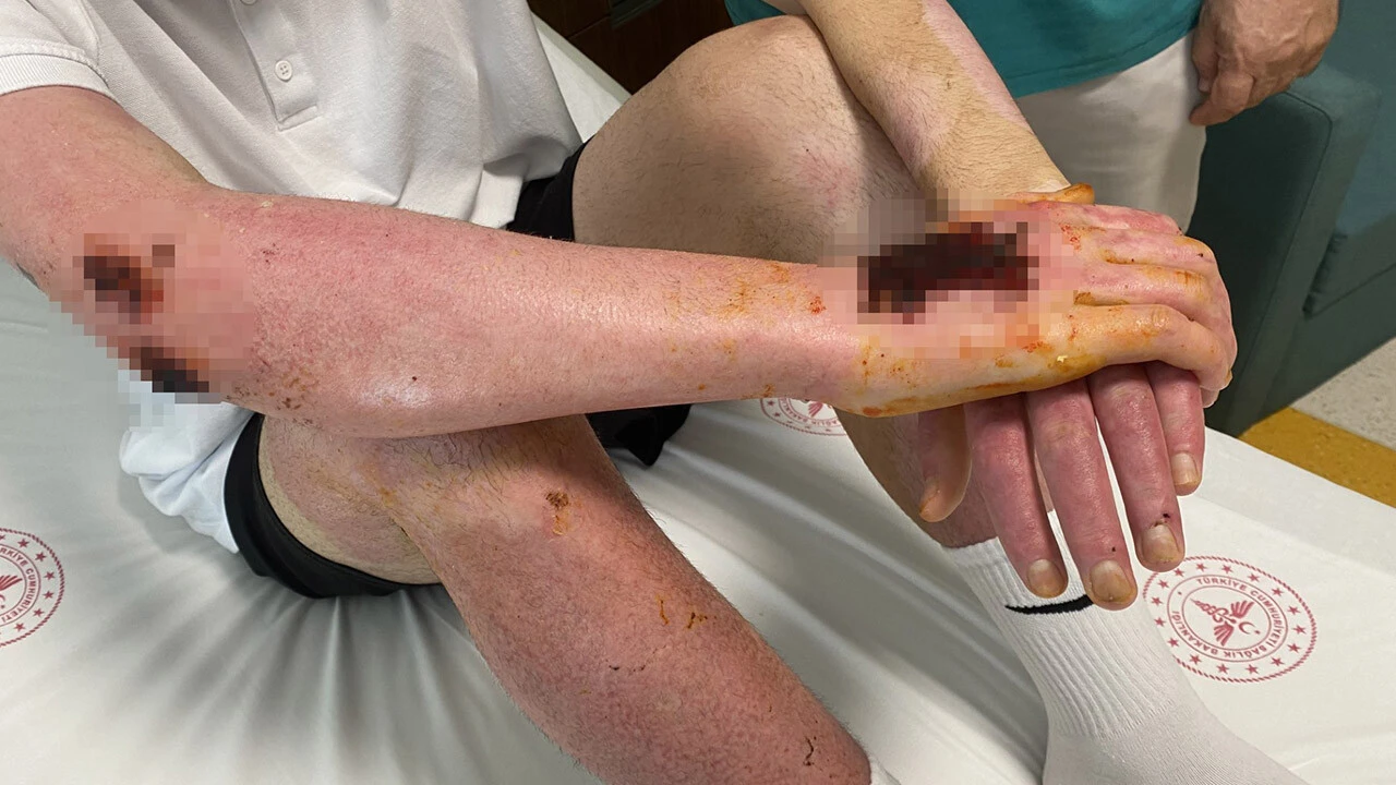 Araç içinde deodorant basılı kaldı, çakmağı çakınca bir anda patladı! 18 gün yoğun bakım, 50 ameliyat...