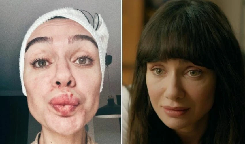 Birce Akalay takipçilerini korkuttu! 'Stresten' diyerek sosyal medyadan paylaştı