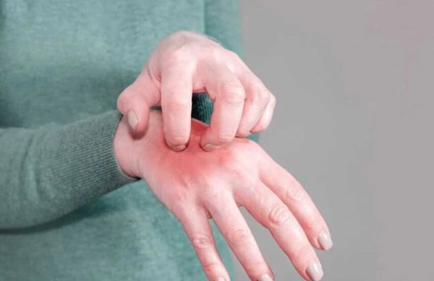 Temasla bulaşıyor, uyuz salgınında vaka artıyor! Uzmanlar uyardı