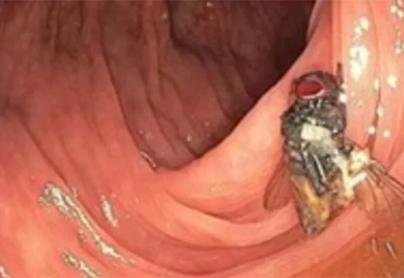 Bağırsaklarında sinek bulunan hasta, doktorları şaşkına çevirdi