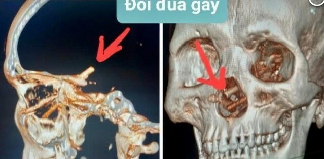 Şiddetli baş ağrısının sebebi kafasındaki yemek çubukları çıktı! 'Nasıl girdi ki?' sorusunun gizemi çözüldü