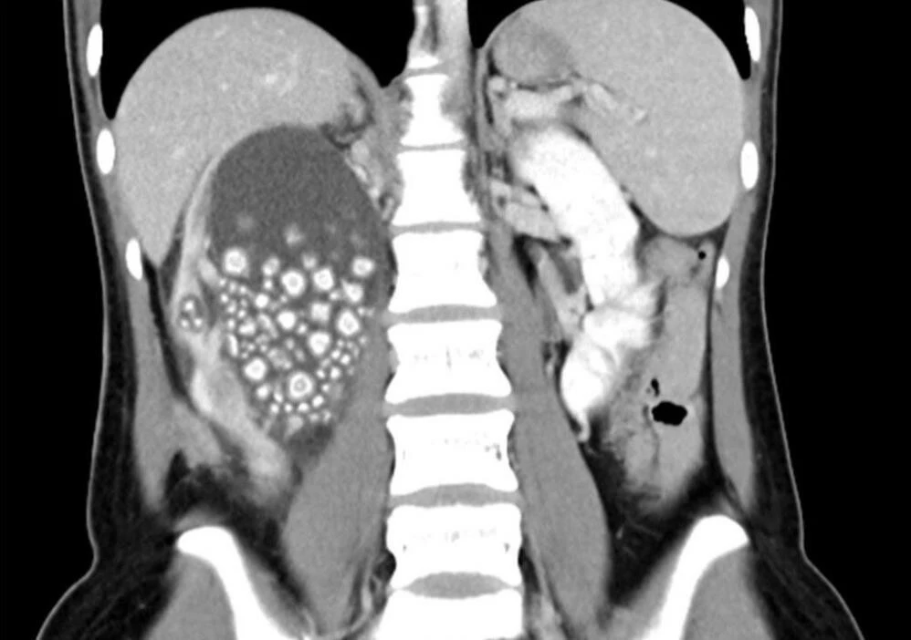 Böbreklerinden 300'den fazla taş çıktı doktor sebebini açıkladı