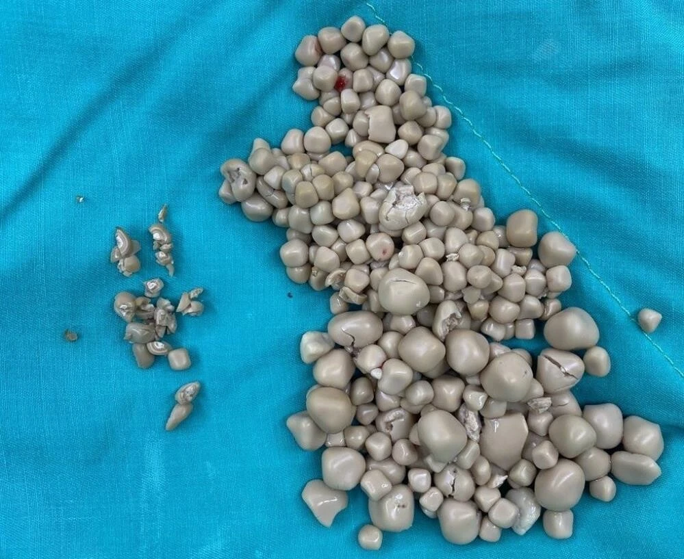 Böbreklerinden 300'den fazla taş çıktı doktor sebebini açıkladı