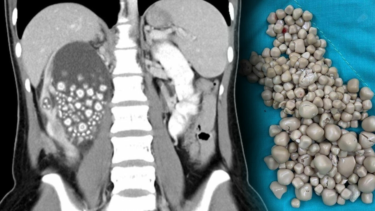 Böbreklerinden 300&#039;den fazla taş çıktı doktor sebebini açıkladı