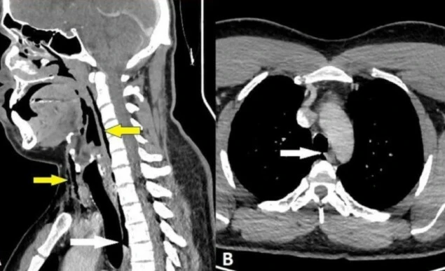 Hapşırığını tutmaya çalışan adam az kalsın hayatından oluyordu!