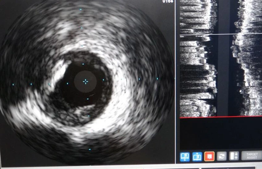 Bölgede ilk kez kullanılan IVUS, çevre illerdeki hastaların umudu oldu