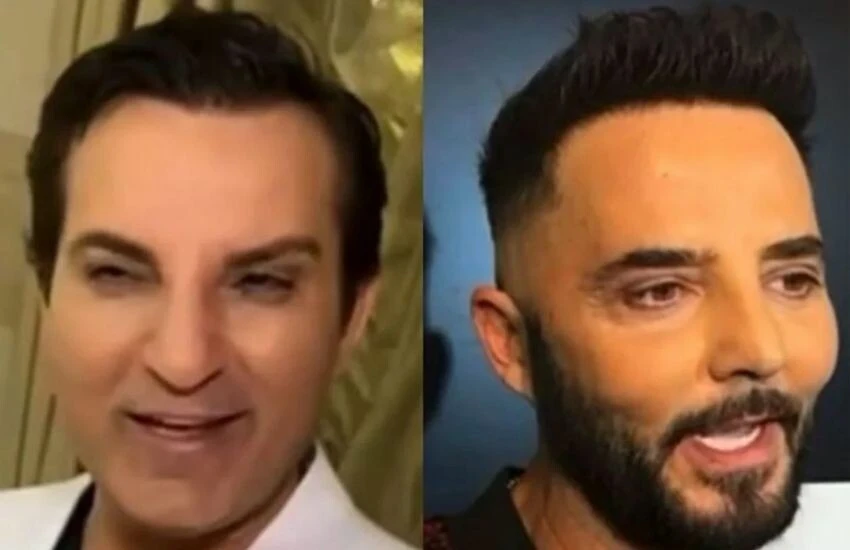 Rafet El Roman'ın ardından Gökhan Özen de botoks kurbanı