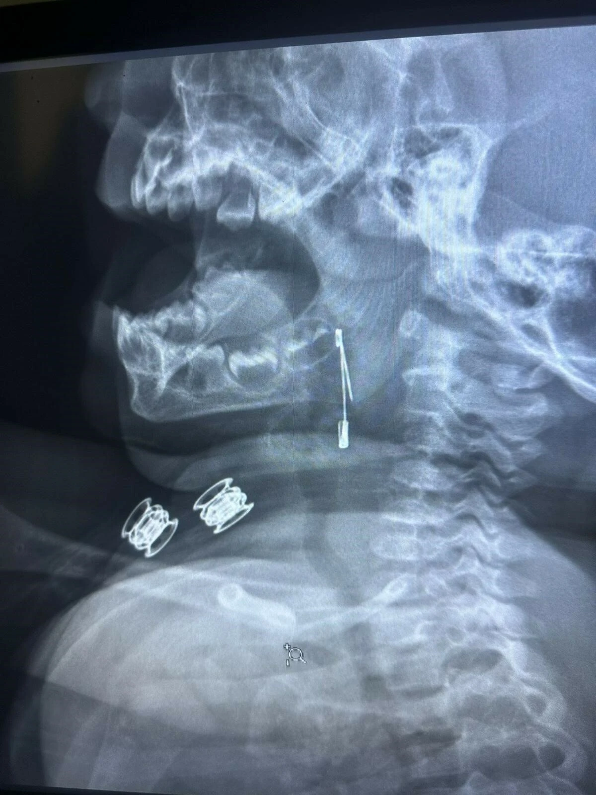 Bitlis'te 8 aylık bebek çengelli iğne yuttu, röntgende görünce şok geçirdiler