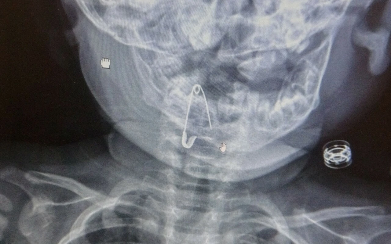 Bitlis'te 8 aylık bebek çengelli iğne yuttu, röntgende görünce şok geçirdiler