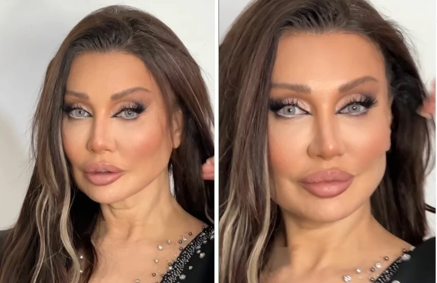 Sanatçı Umut Akyürek'e alın daraltma ameliyatı sonrası eleştiri yağdı