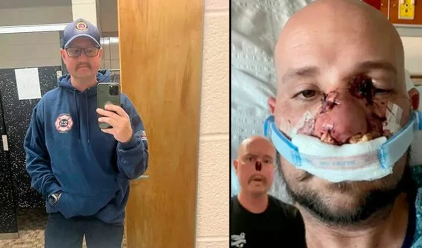 Bir hapşırıkla ölebilirsiniz! Grip gibi başladı yüzünün bir kısmını kaybetti