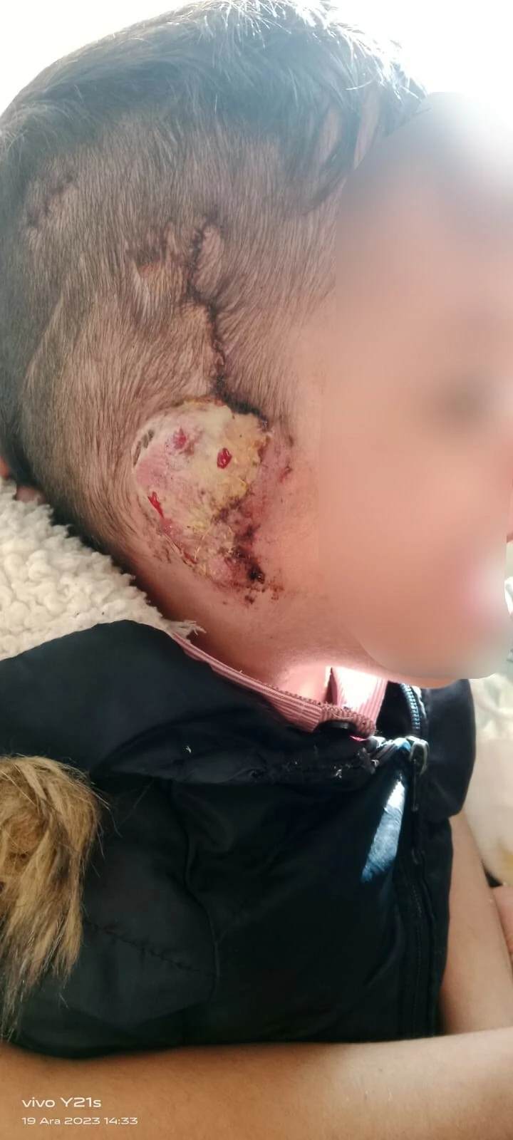 4 yaşındaki çocuğu 7 kere ameliyat edip kulağını çürüttüler! - 3. Resim