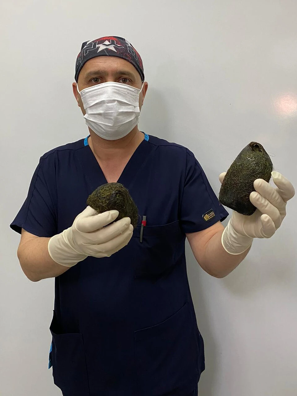 Rapunzel sendromu: Mide ve bağırsağından 2 kilo saç çıktı!