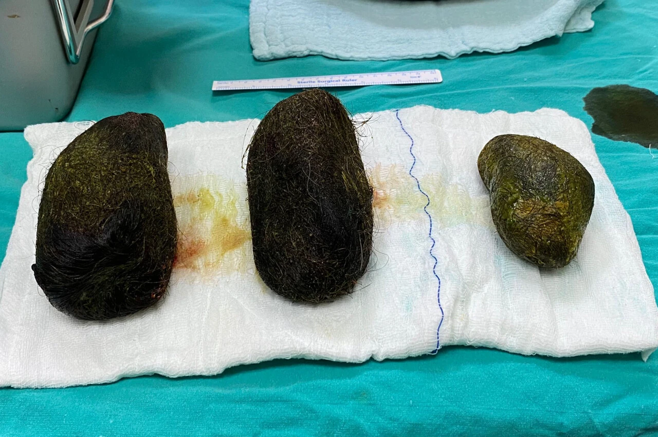 Rapunzel sendromu: Mide ve bağırsağından 2 kilo saç çıktı!