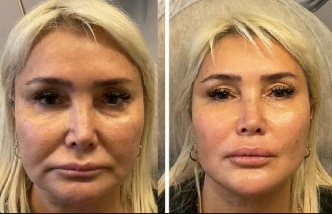 Estetik furyasına Yonca Evcimik de katıldı! 60 yaşındaki şarkıcı bambaşka biri oldu - 1. Resim