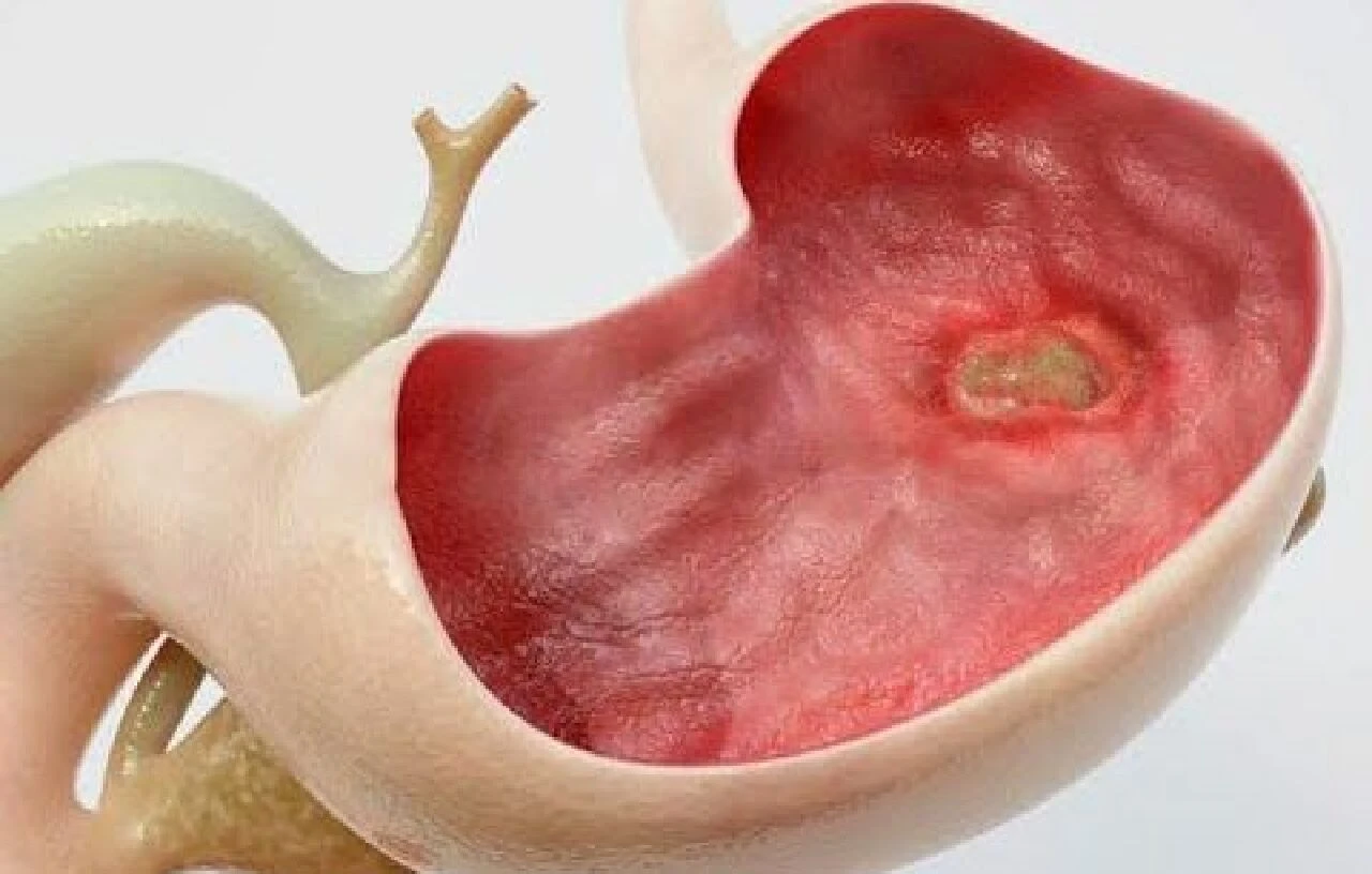 Ramazan ayında karın şişliği neden olur? Uzmanından şaşırtan açıklama... - 5. Resim