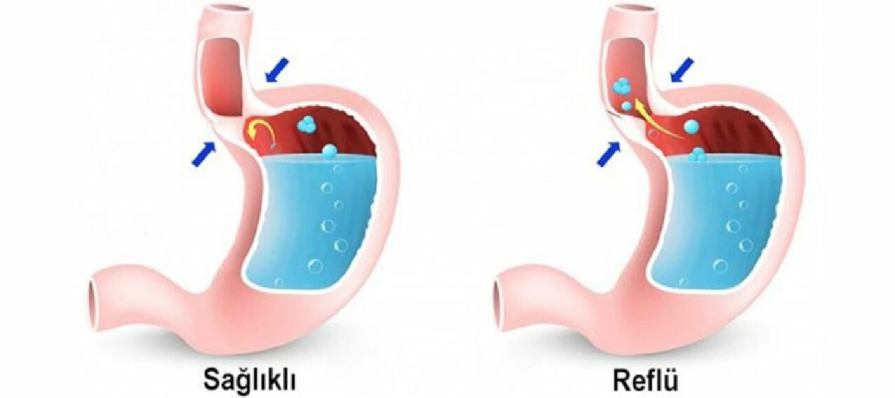 Ramazan ayında karın şişliği neden olur? Uzmanından şaşırtan açıklama... - 4. Resim
