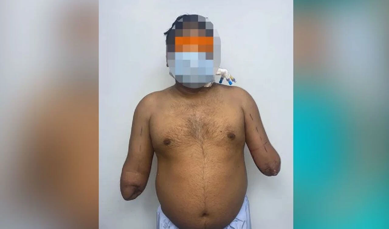 Tren kazasında kollarını kaybeden erkek ressamın artık kadın elleri var