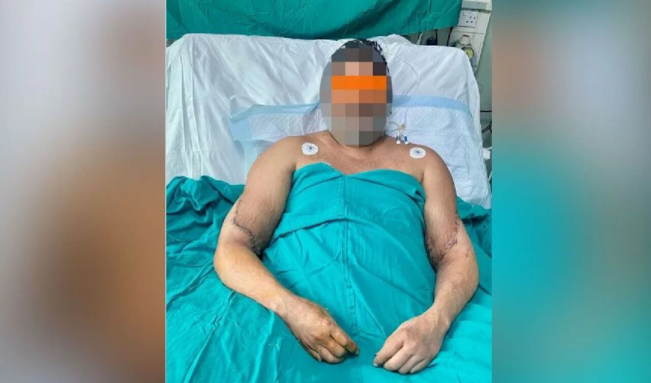 Tren kazasında kollarını kaybeden erkek ressamın artık kadın elleri var