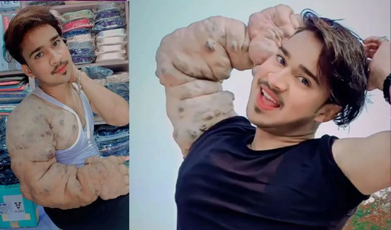 Teşhis konulamayan hastalık onu fenomen yaptı! Kolu tam 9 kilo ağırlığında