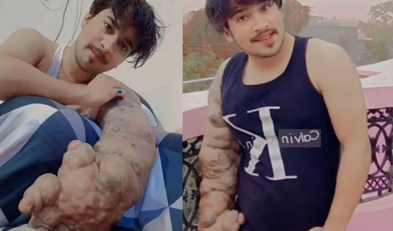 Teşhis konulamayan hastalık onu fenomen yaptı! Kolu tam 9 kilo ağırlığında