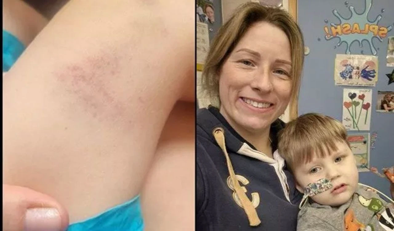 Çocuktaki morlukları önemsemeyen doktorlar büyük yanılgıya uğradı! Annenin acı tecrübesi
