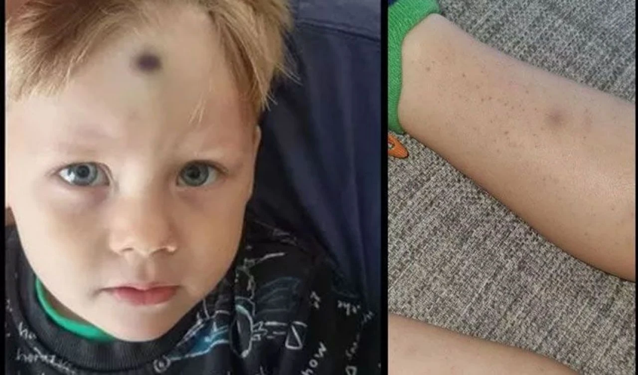 Çocuktaki morlukları önemsemeyen doktorlar büyük yanılgıya uğradı! Annenin acı tecrübesi